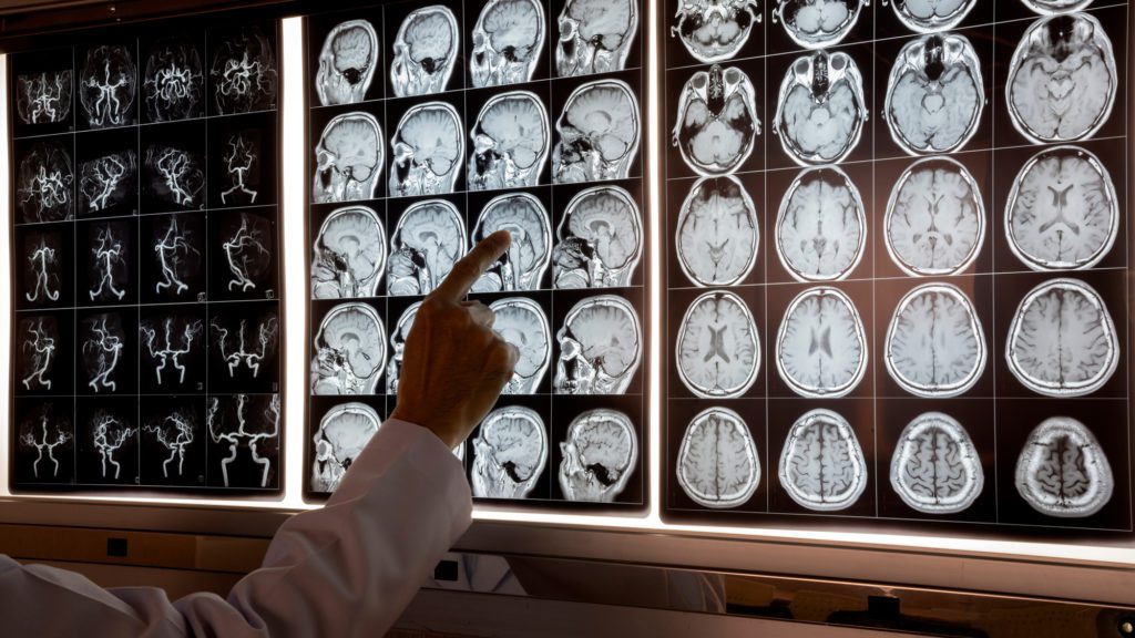 doctor pointing to brain scans